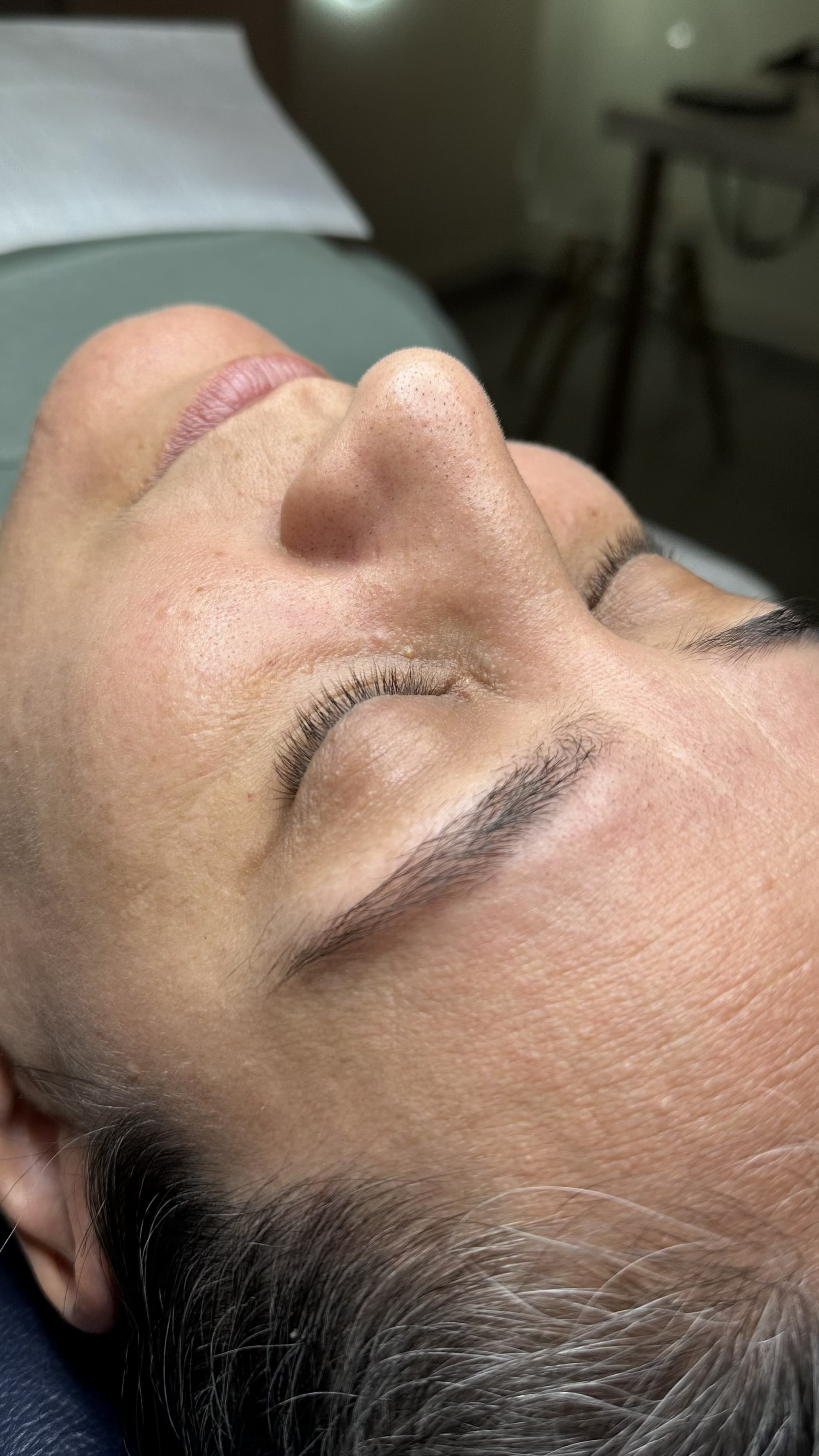 Tratamento para acne — antes, caso 1