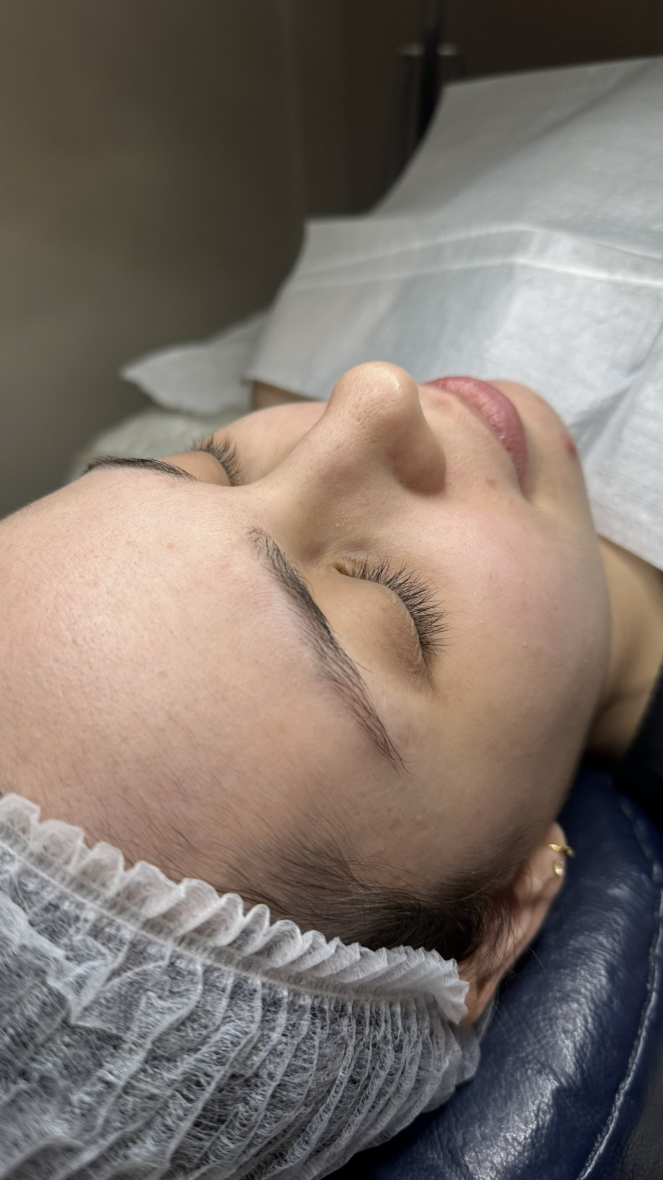 Tratamento para acne — antes, caso 2