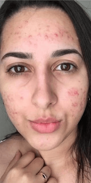 Tratamento para acne — antes, caso 3