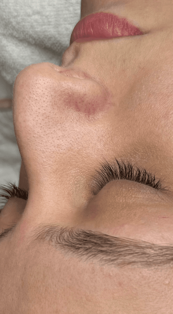 Controle da acne com acompanhamento personalizado e foco em recuperação da pele. — antes, caso 4