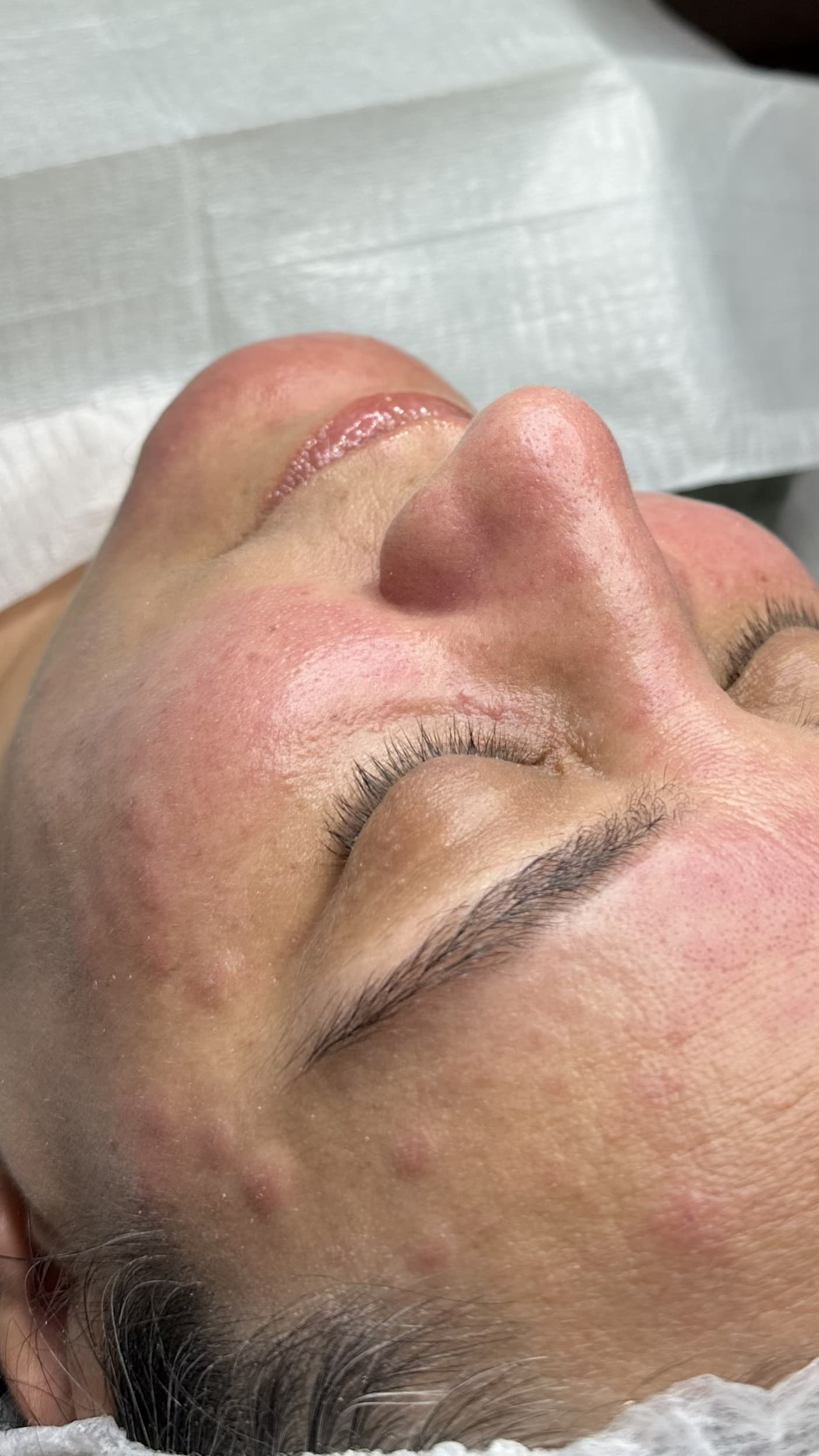 Tratamento para acne — depois, caso 1