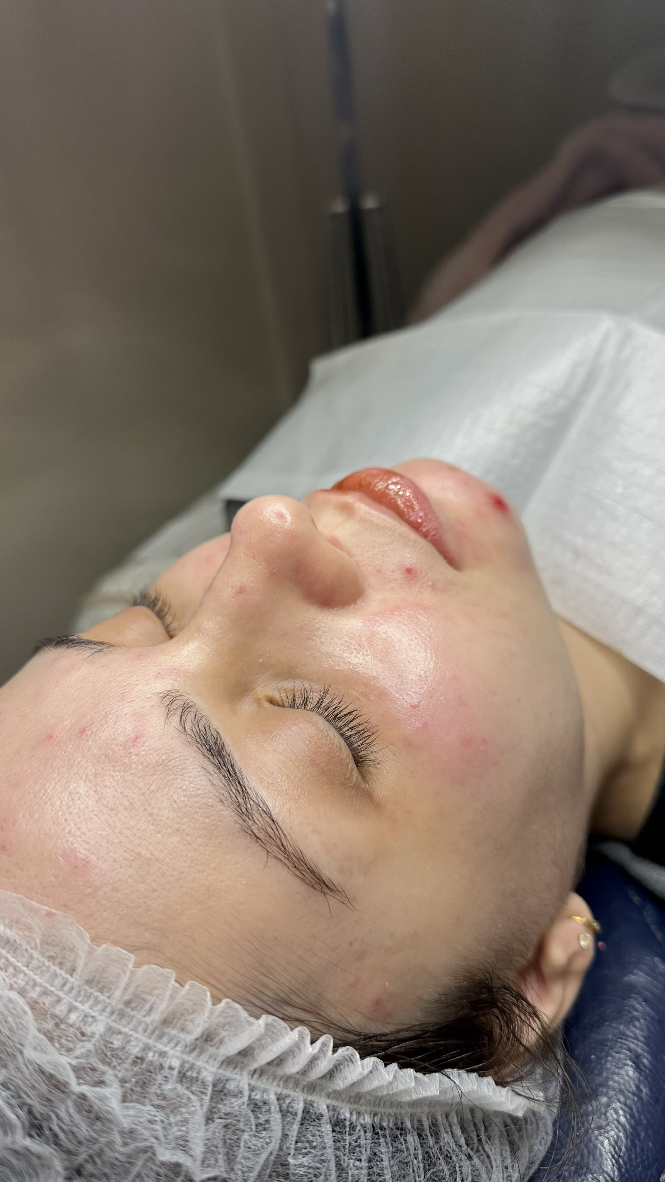 Tratamento para acne — depois, caso 2