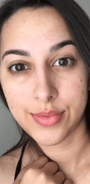 Tratamento para acne — depois, caso 3
