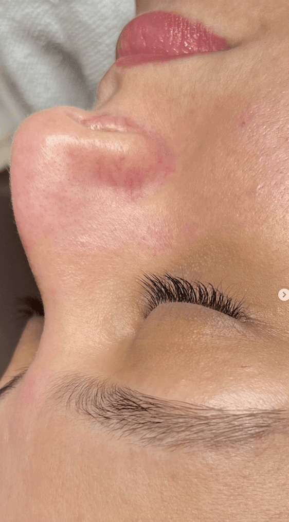 Controle da acne com acompanhamento personalizado e foco em recuperação da pele. — depois, caso 4