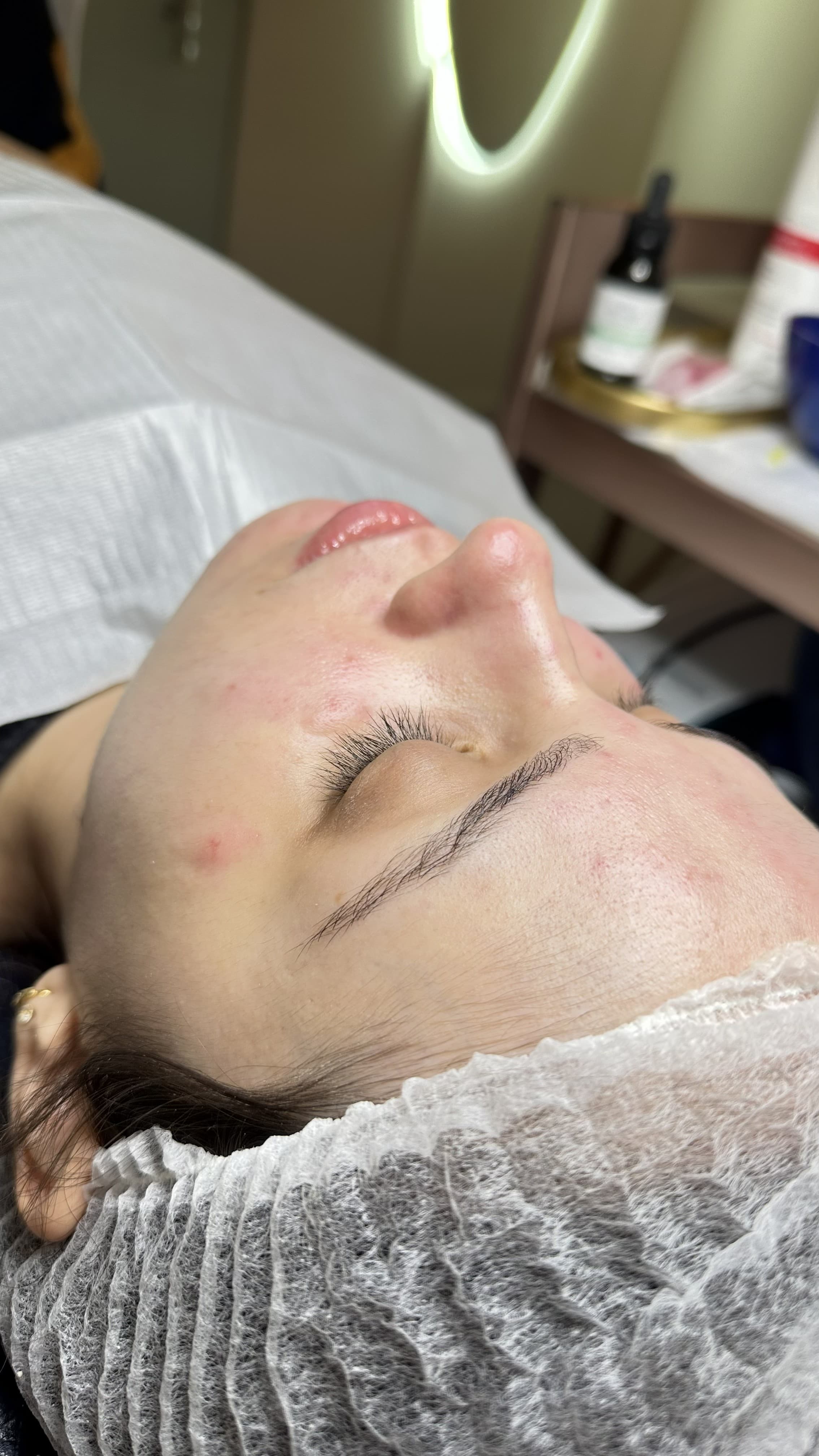 Tratamento para acne — como funciona, etapa 1