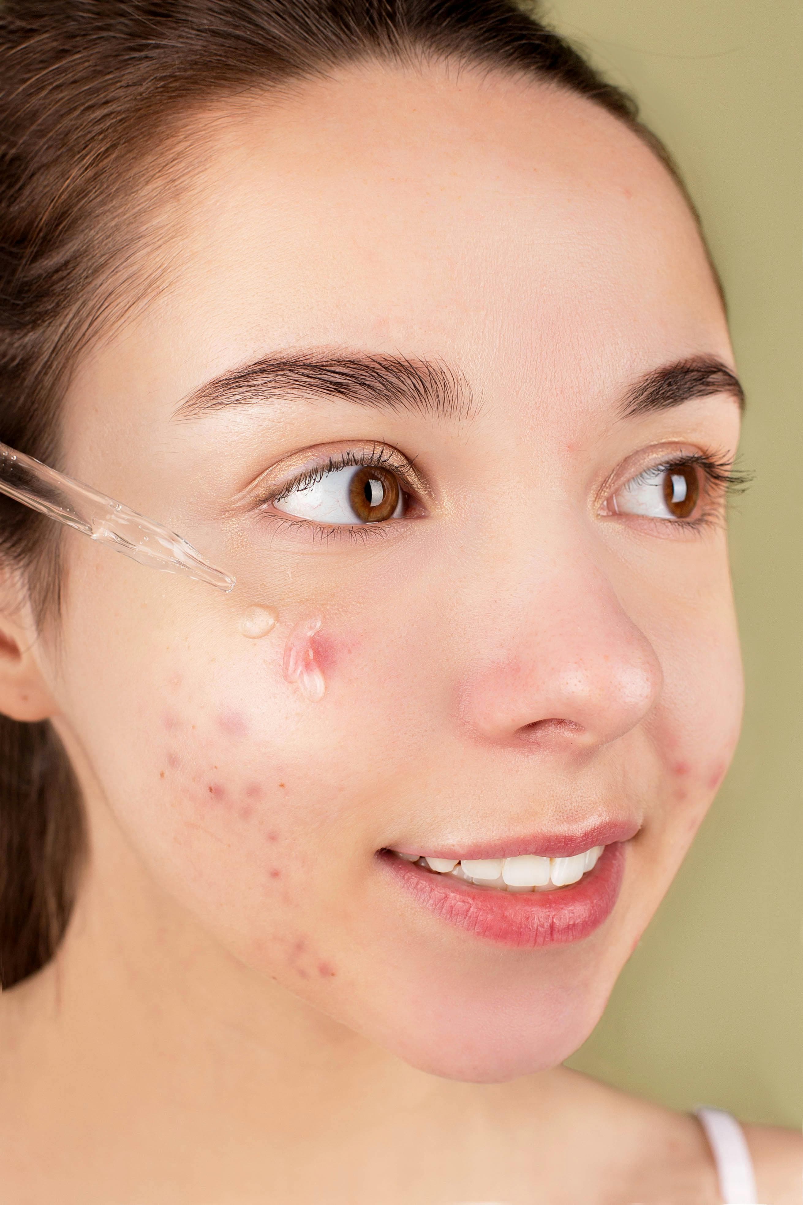 Tratamento para acne — região tratada, imagem 2