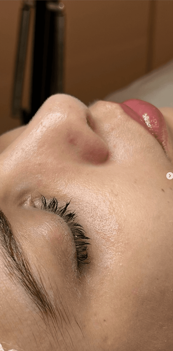 Tratamento para acne — imagem do tratamento
