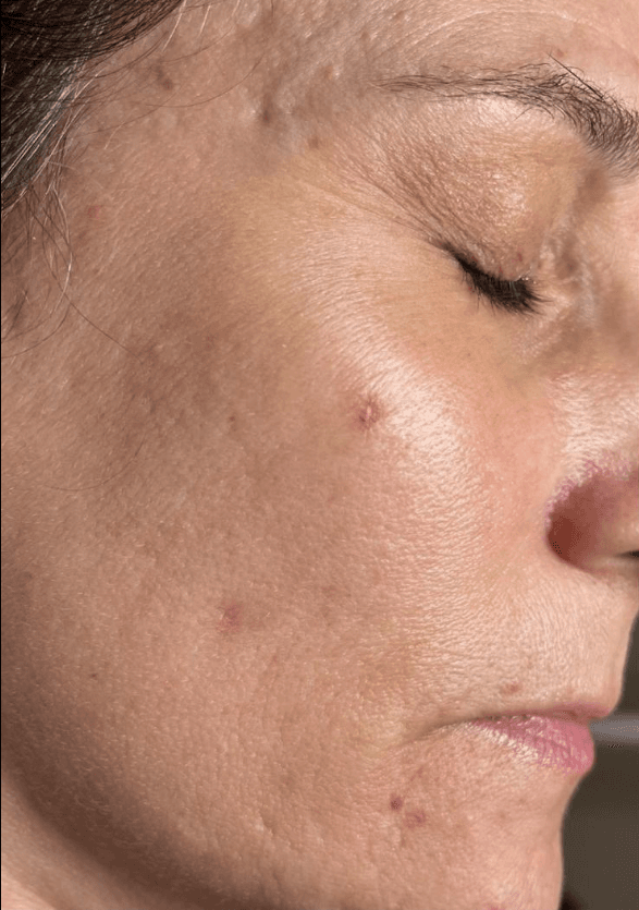 Rejuvenescimento facial — antes, caso 1