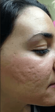 Rejuvenescimento facial — antes, caso 2