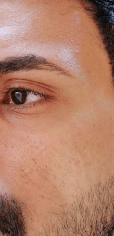 Rejuvenescimento facial — antes, caso 3