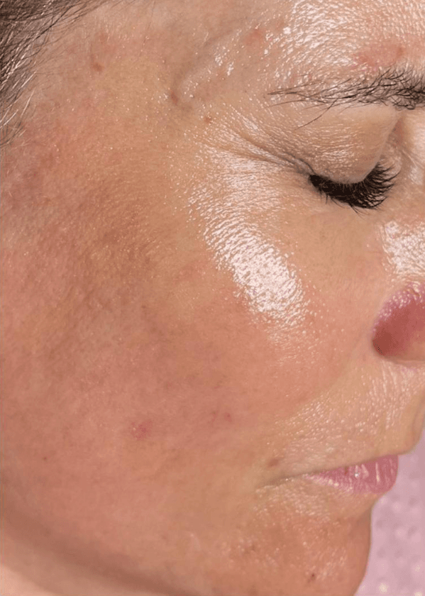Rejuvenescimento facial — depois, caso 1