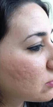 Rejuvenescimento facial — depois, caso 2