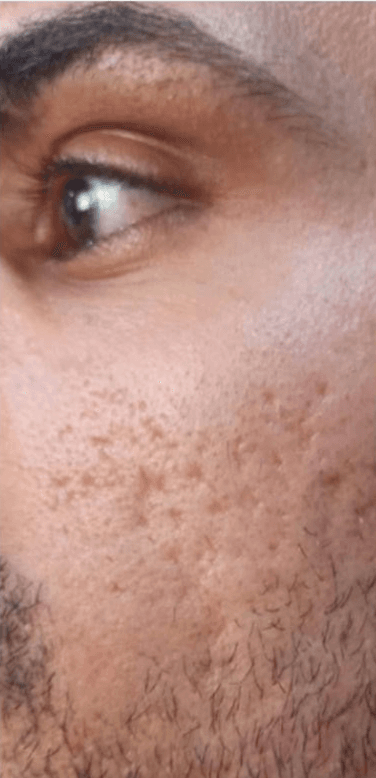 Rejuvenescimento facial — depois, caso 3
