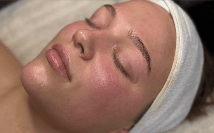 Rejuvenescimento facial — benefício 1