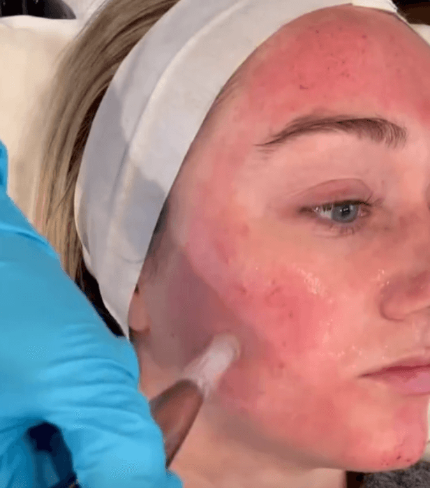 Rejuvenescimento facial — como funciona, etapa 1
